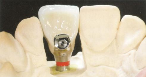 IMPLANTES DENTALES